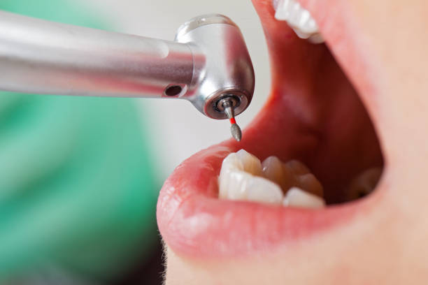 Best Emergency Treatment for Oral Infections in Meron Park, CA